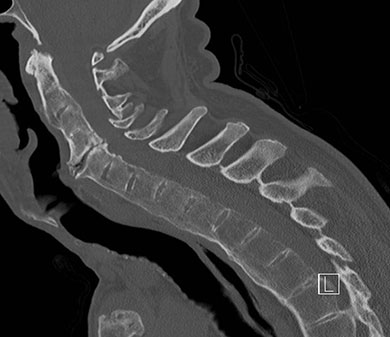 Case courtesy of Dr Ian Bickle, Radiopaedia.org, rID: 26910